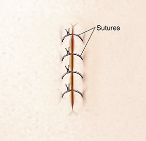 sutures suture care stitches bleeding stop wound incision help heal healing wounds speed close used also