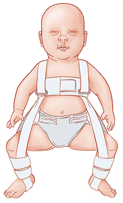 Hip displacement in babies hotsell