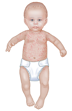 Can my baby get a rash from a fever