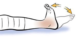 How to Elevate the Leg After Knee Replacement 