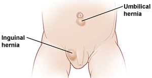 Hernias In The Newborn Saint Luke S Health System