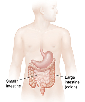 Bowel Obstruction or Intestinal Blockage