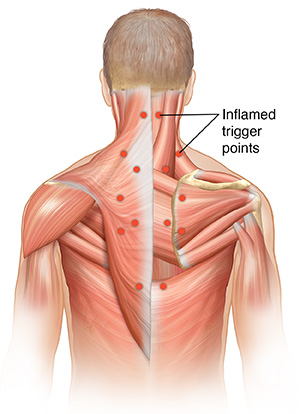 Learning About Trigger Point Injections