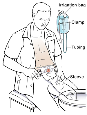 Hasil gambar untuk irrigation colostomy