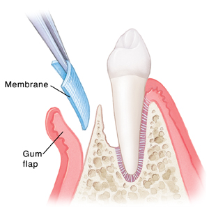 Periodontal Disease: Guided Tissue Regeneration (GTR) | Saint Luke's ...