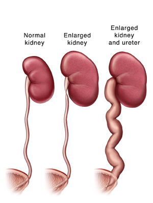 what causes an enlarged kidney in a child