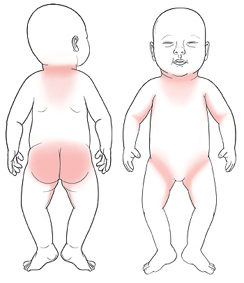 https://api.kramesstaywell.com/Content/6066ca30-310a-4170-b001-a4ab013d61fd/ucr-images-v1/Images/outline-of-baby-from-back-with-shaded-areas-around-neck-and-on-buttocks-and-inner-thighs-outline-of-baby-from-front-with-shaded