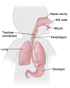 When Your Child Needs A Nasogastric Ng Tube Saint Luke S Health System