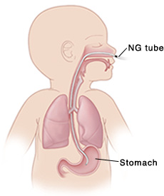 Outline of baby with head turned to side showing NG tube in nose, down back of throat, into esophagus, and ending in stomach. Lungs are shown in chest with airway in front of esophagus. Mark on NG tube is at nose.