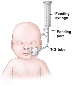 Outline of baby's head and chest showing NG tube in nose connected to feeding port and feeding syringe.