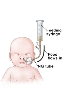 Outline of baby's head and chest showing NG tube in nose connected to feeding port and feeding syringe. Liquid food in feeding syringe flows into baby through NG tube.