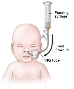 feeding tube syringe ng nasogastric nose child connected baby through gravity health types chest liquid port keep into