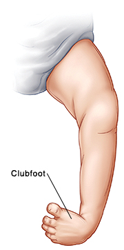 When Your Child Has Clubfoot | Saint Luke's Health System