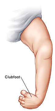 When Your Child Has Clubfoot Saint Luke S Health System