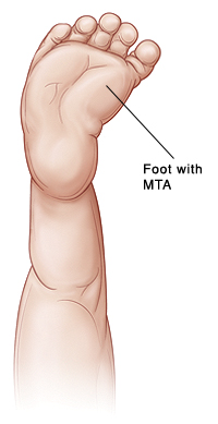 Outline of baby's leg showing front part of foot turned inward (MTA).'s leg showing front part of foot turned inward (MTA).