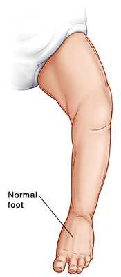 Outline of baby's leg showing normal foot.