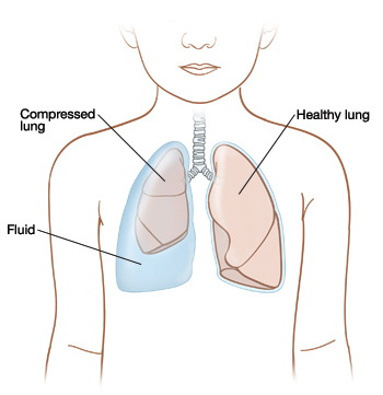 outline of child showing fluid trapped between compressed lung and body wall on right side healthy lung on left 101016
