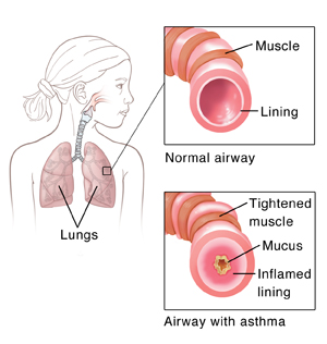 Steroids for asthma treatment