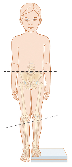 When Your Child Has Leg-Length Discrepancy (LLD)