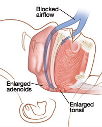 enlarged tonsils snoring adults