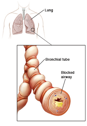 Chest Cold (Acute Bronchitis), Antibiotic Use