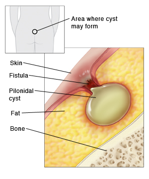 Outline of human figure from the back showing buttocks with small circle above buttocks crease showing where cyst may form. Closeup of section of skin, fat, and bone. Pilonidal cyst is in fat layer, connected by fistula to skin. Skin around fistula is inflamed.