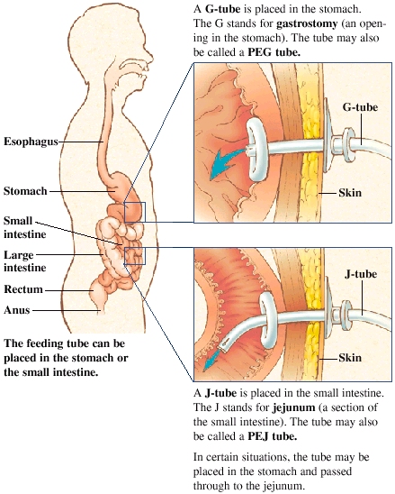 Understanding Peg Tube Feeding Saint Luke S Health System