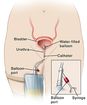 outline of human figure showing bladder with catheter and urine bag on leg