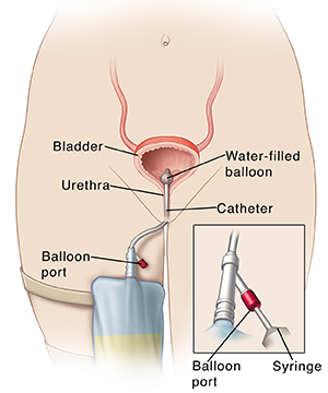 Foley Catheter Removal Saint Luke S Health System