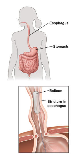 Esophageal Dilation Saint Luke S Health System