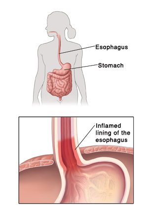 Outline of human figure showing digestive system and pointing out esophagus and stomach. Detail of closeup of lower esophagus where it connects to stomach. Lining of esophagus is inflamed.