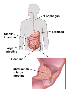 cancer colon blockage