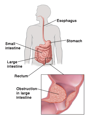 Large Bowel Obstruction  Saint Luke's Health System