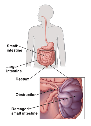 Bowel Obstruction: Signs & Symptoms, Causes, Treatment