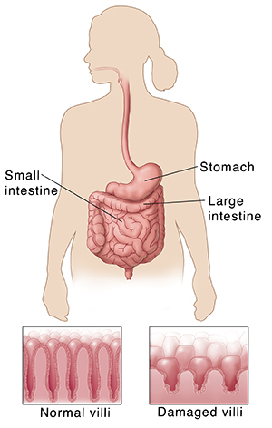 Celiac Disease Saint Luke S Health System