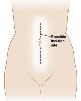 Patient 1 with open abdomen condition after damage- control laparotomy.