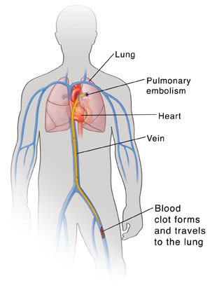 Pulmonary Embolism  Saint Luke's Health System