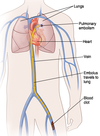 Outline of human torso showing heart, lungs, and major veins. Blood clot is in leg vein with arrow showing it traveling up vein to lung causing pulmonary embolism.