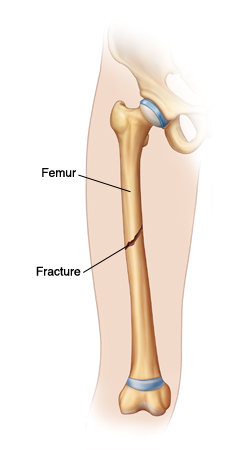 HE'S BACK: After suffering a compound-leg fracture in London