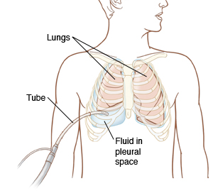 How Is A Thoracentesis Done : How To Do Thoracentesis – EJZV