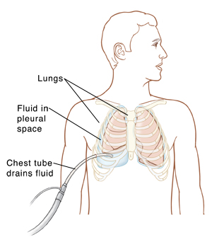 About Your Chest Tube Placement Procedure