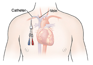 Outline of man's chest showing heart and lungs with central line in place.