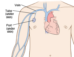 Implanted Chemo Port - An implanted device allowing easy access to the  veins for chemotherapy