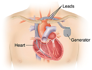 Biventricular Pacemaker And Icd Biventricular Icd Saint Luke S Health System