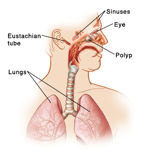 Outline of man's head and chest with head turned to side. Inside of nose and mouth are visible. Trachea leads from throat and branches into lungs. Sinuses are spaces in head, some filled with fluid with swollen lining from nasal allergies. Polyps are deep inside nose. Fluid dripping from nose lining down back of throat. Eye is red and swollen.