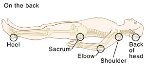 Spinal Cord Injury (SCI) and Pressure Injuries | Saint Luke's Health System