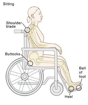 Outline of person sitting in wheelchair with bones visible. Circles indicate pressure points: Shoulder blade, buttocks, ball of foot, heel.