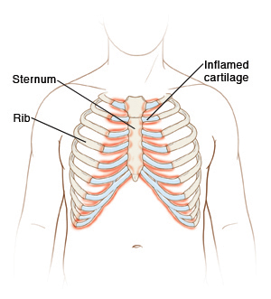 Outline of torso showing ribcage with inflamed cartilage.