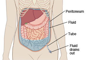 Outline of woman's abdomen showing tube inserted through skin into abdomen to drain fluid out.