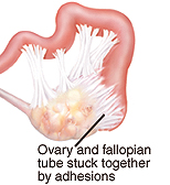 What Causes Scarring Of The Fallopian Tubes? – OBAULW